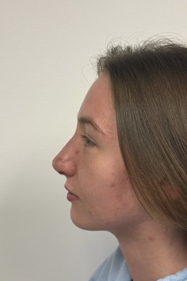 After Image: Rhinoplasty - left-side