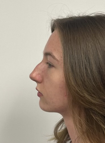 Before Image: Rhinoplasty - left-side