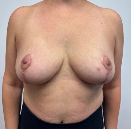 After Image: Breast Reduction - front