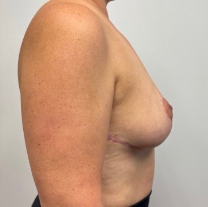 After Image: Breast Reduction - right-side