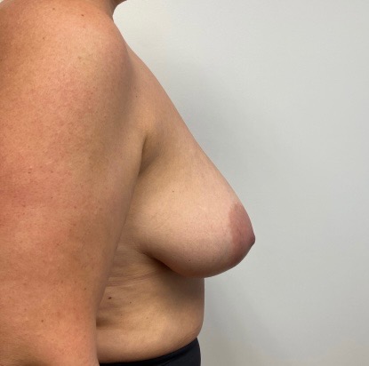 Before Image: Breast Reduction - right-side