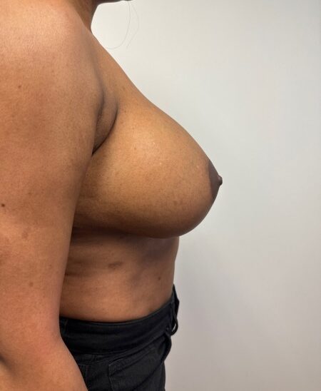 Before Image: Implant Removal - right-side