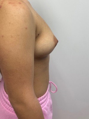 Before Image: Breast Augmentation - right-side