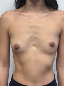 Before Image: Breast Augmentation