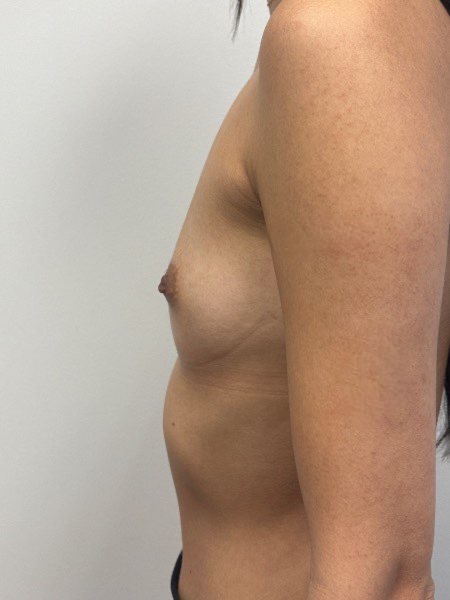 Before Image: Breast Augmentation - left-side