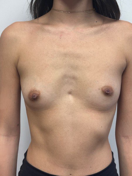 Before Image: Breast Augmentation - front