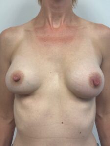 After Image: Breast Augmentation