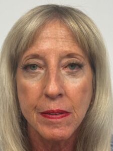 After Image: Blepharoplasty