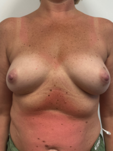 Before Image: Breast Augmentation