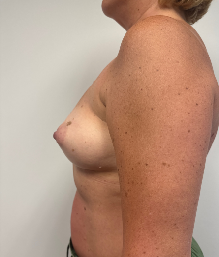 Before Image: Breast Augmentation - left-side