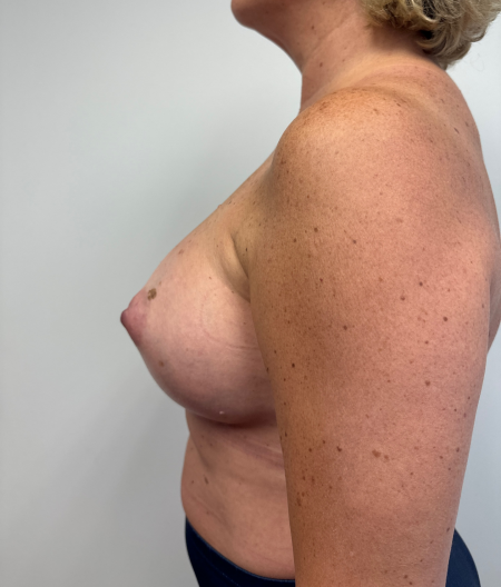 After Image: Breast Augmentation - left-side