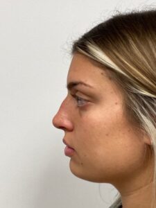 Before Image: Rhinoplasty 