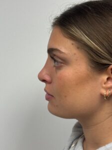 After Image: Rhinoplasty 