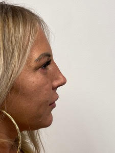 Before Image: Rhinoplasty