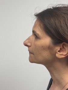 Before Image: Rhinoplasty