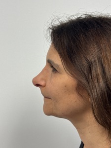 After Image: Rhinoplasty