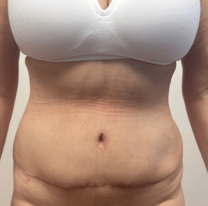 After Image: Abdominoplasty