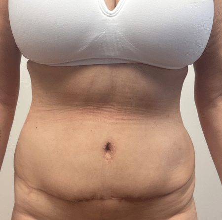 After Image: Abdominoplasty - front