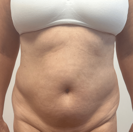 Before Image: Abdominoplasty - front
