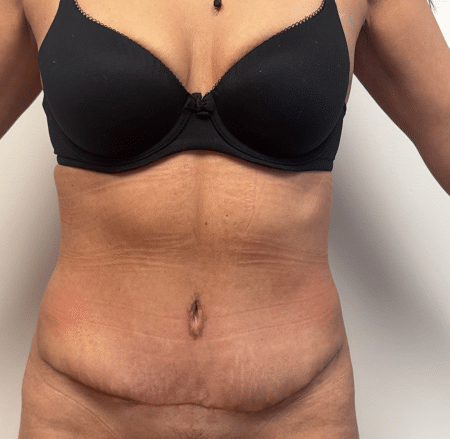 After Image: Abdominoplasty - front