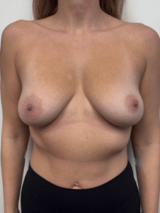Before Image: Breast Augmentation