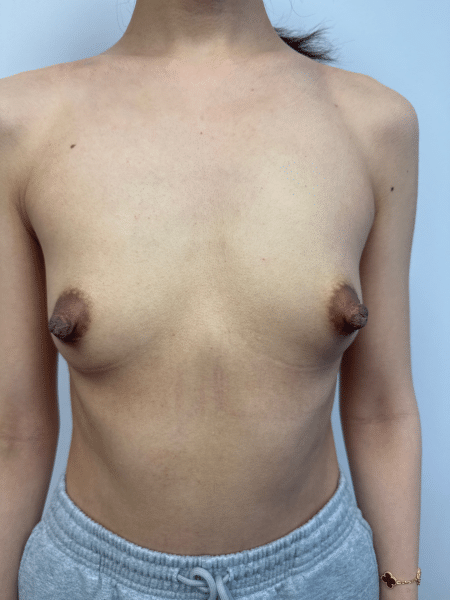 Before Image: Breast Augmentation - front