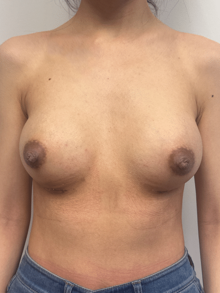 After Image: Breast Augmentation - front