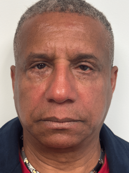 After Image: Blepharoplasty - front